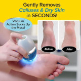 جهاز إزالة الجلد الميت وتشقق القدمين مع شفط وفلتر Rechargeable Callus Remover with Vacuum & LED Light جهاز إزالة الجلد الميت وتشقق القدمين مع شفط وفلتر Rechargeable Callus Remover with Vacuum & LED Light